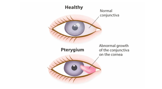 Pterygium Surgery Sutureless