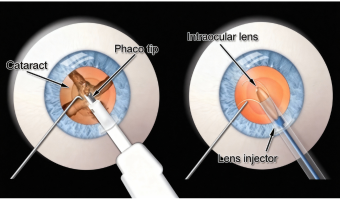Phaco Cataract Surgery