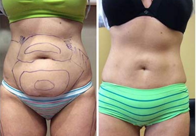 Liposuction Belly Fat