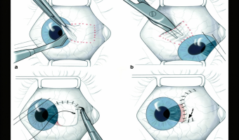 Pterygium Surgery With Sutures