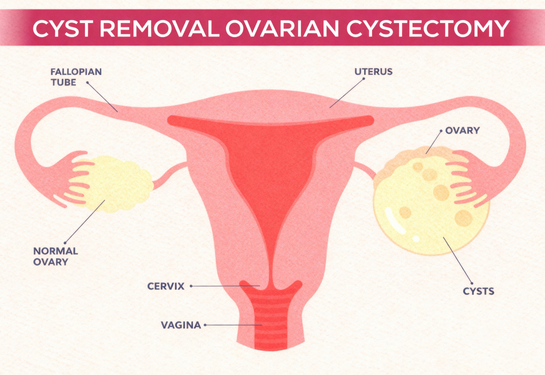  Ovarian (Benign) Cystectomy / Oophorectomy