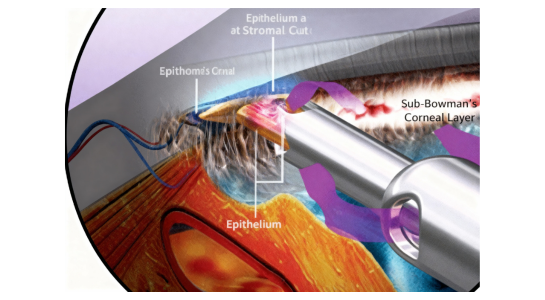 Minimally Invasive Glaucoma Surgery (MIGS) 