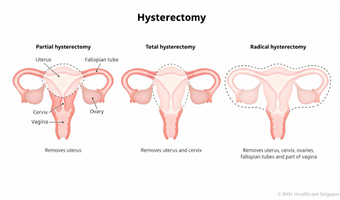 Hystrectomy