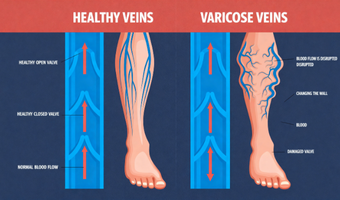 Varicose Glue one side