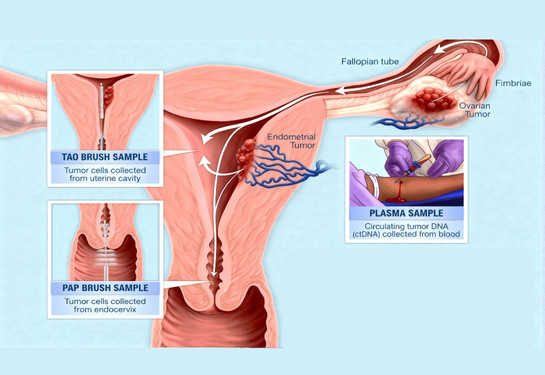 Uterine Cancer Surgery