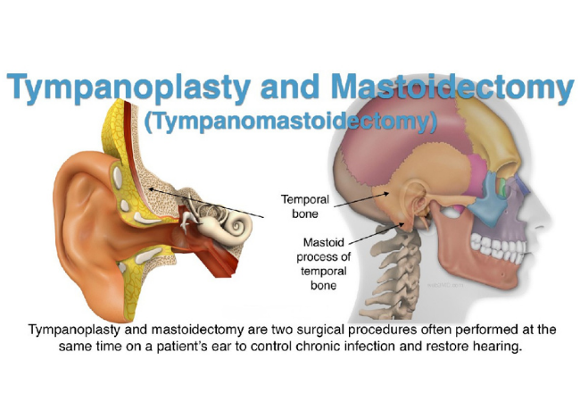 Tympanoplasty with Cortical Mastoidectomy