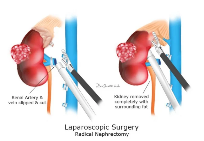 Laparoscopic Radical Nephrectomy