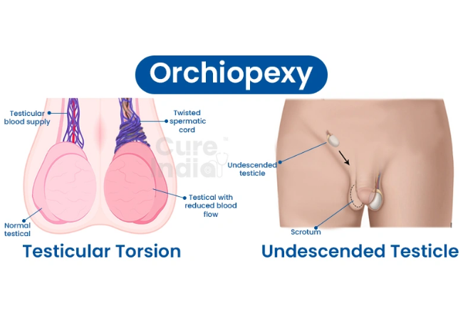 Testis Fixation (Surgery Orchidopexy Unilateral )