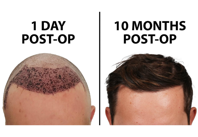 Hair Transplant