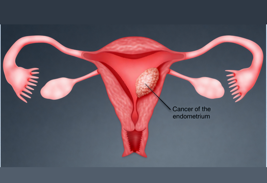 Endometrial Cancer Surgery