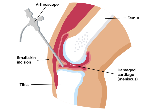 Arthroscopic Meniscus Repair