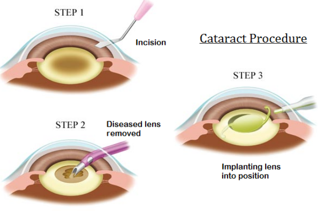 Cataract Surgery SICS(Small Incision Cataract Surgery)