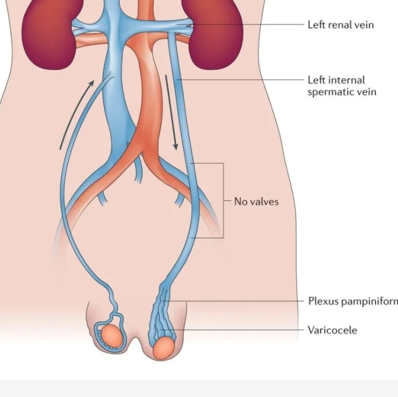 Varicocele Embolisation One Side