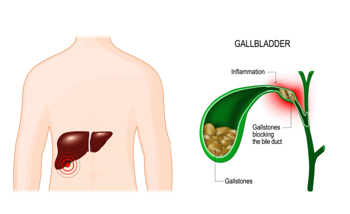 Gallstones