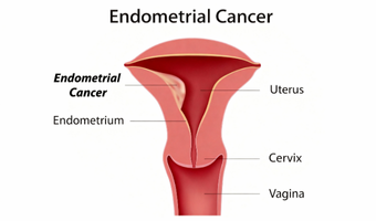 Endometrial Cancer Surgery
