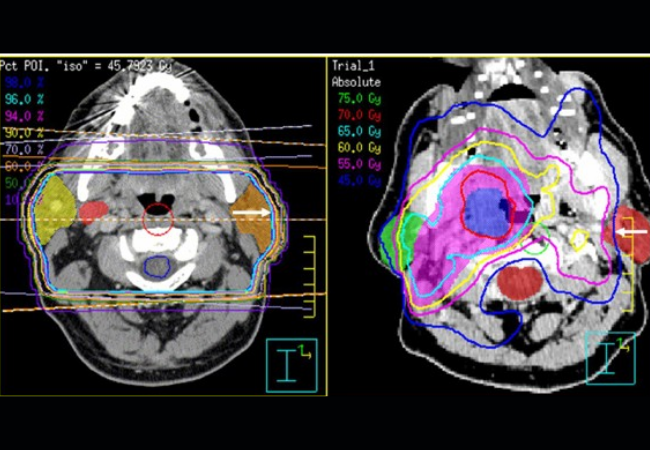 Intensity-Modulated Radiation Therapy(IMRT)