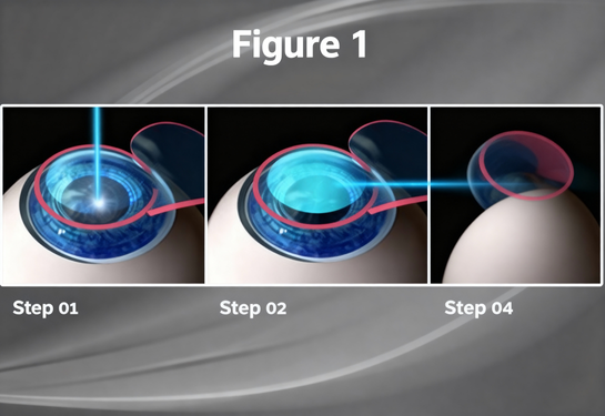 Bladeless Femto LASIK