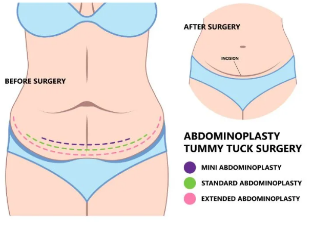 Abdominoplasty