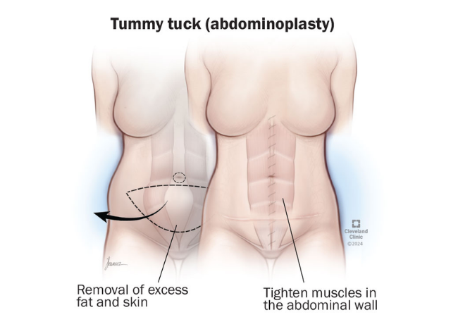 Tummy tuck