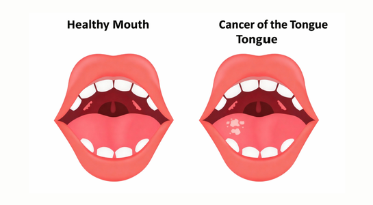Small Tongue Cancer with Neck Dissection