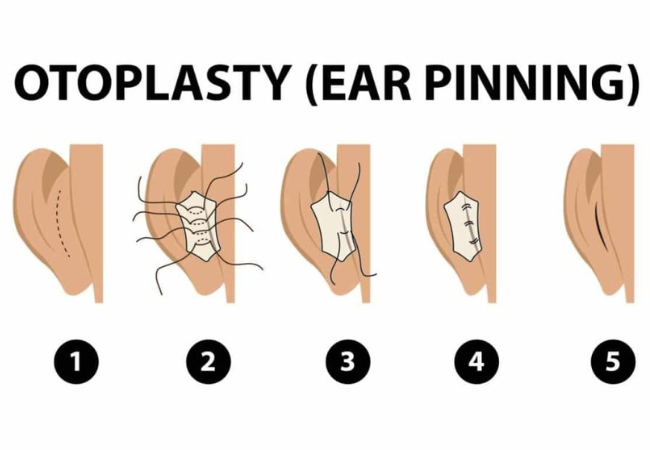 Otoplasty