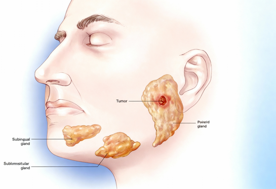 Parotid Surgery
