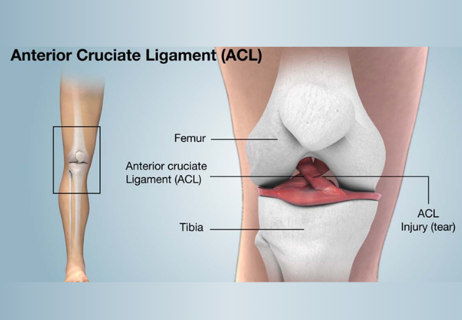 Arthroscopic Anterior Cruciate Ligament (ACL) - Posterior Cruciate Ligament(PCL) Reconstruction