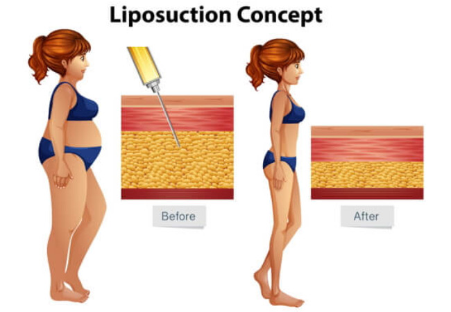 Other Liposuction