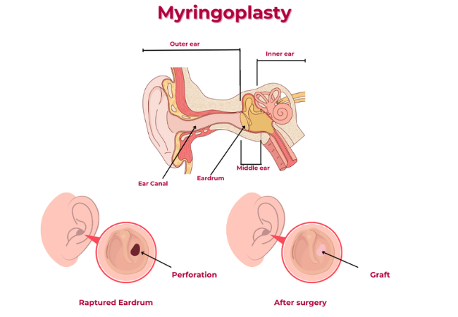 Myringoplasty