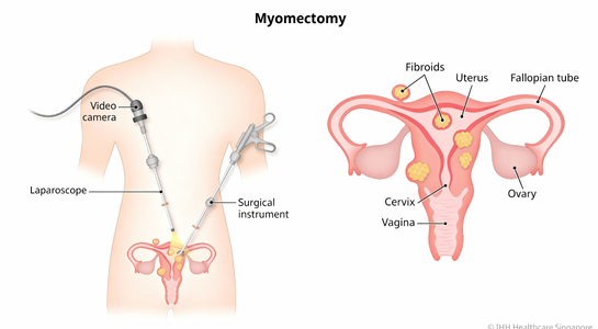 Myomectomy