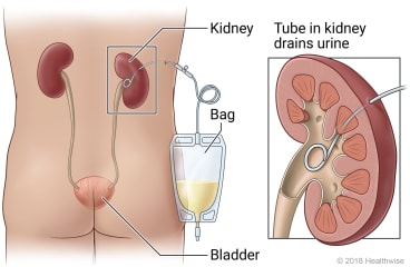 Bilateral PCN
