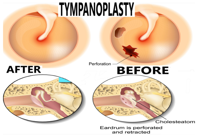 Tympanoplasty