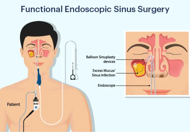 Septo-Functional Endoscopic Sinus Surgery(FESS)