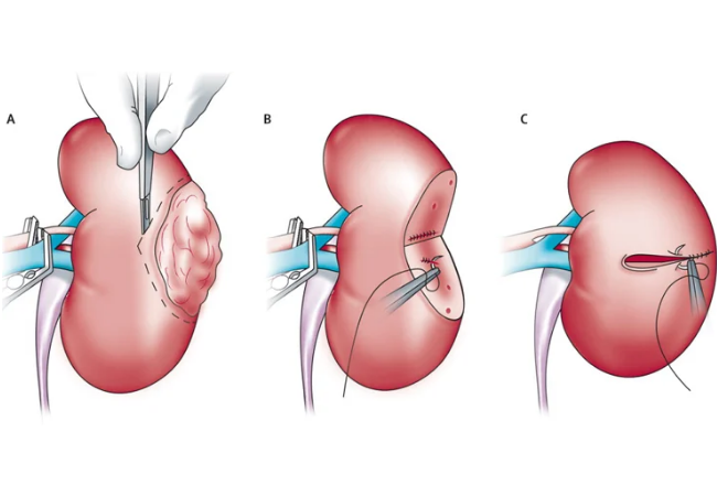 Laparoscopic Nephrectomy