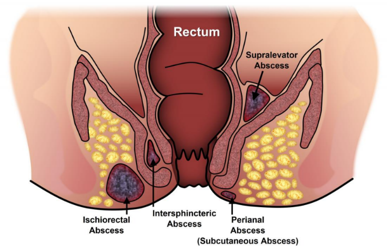 Fistula