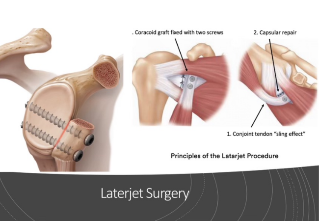 Shoulder - Latarjet