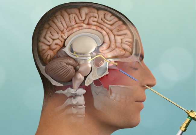 Endoscopic pituitary surgery