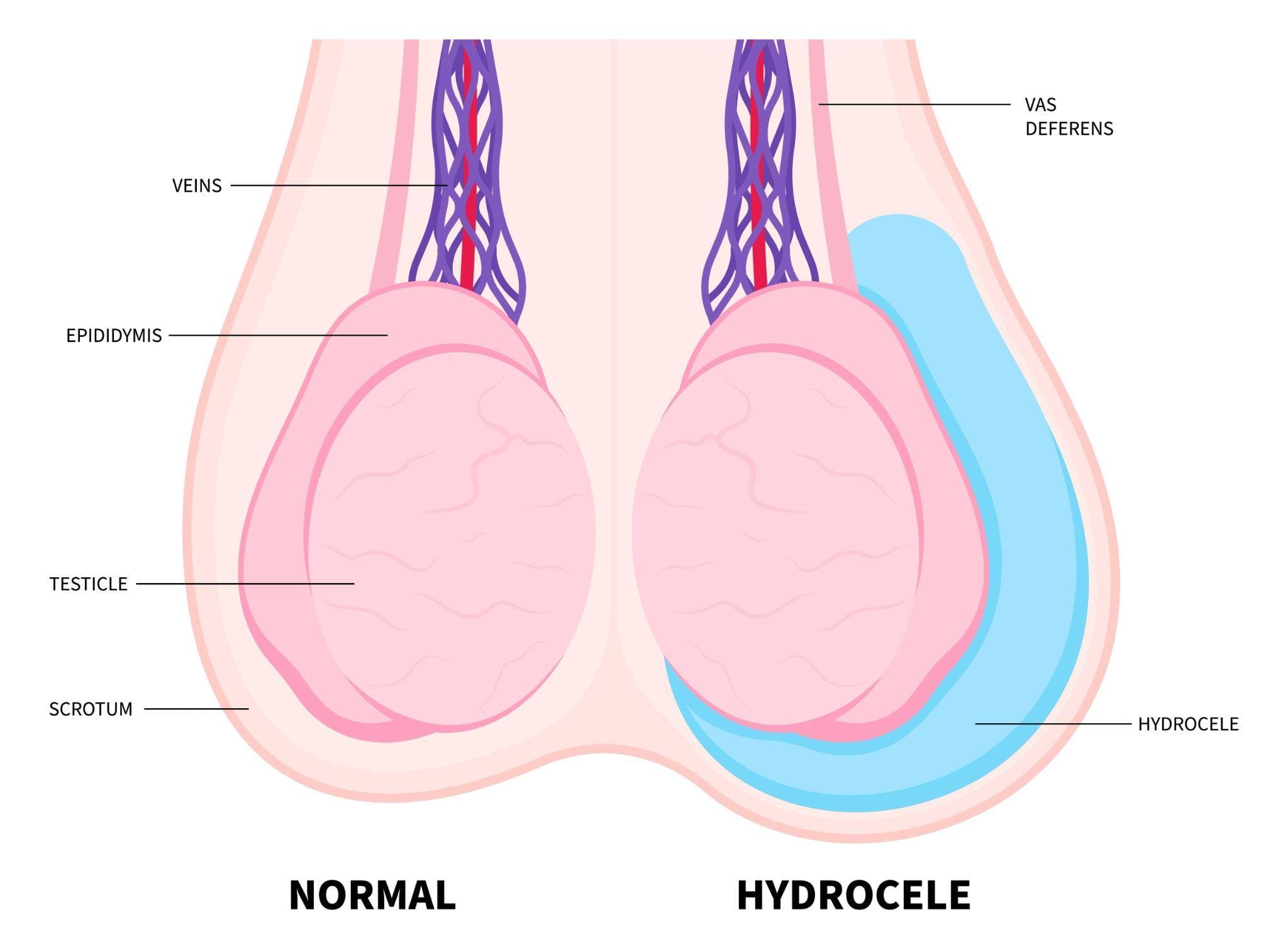 Hydrocele