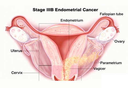 CA Endometrium