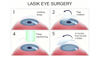 LASIK PRP(Pan-Retinal Photocoagulation)