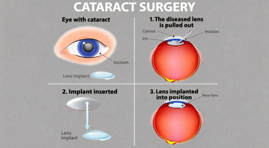 Phaco Cataract Surgery